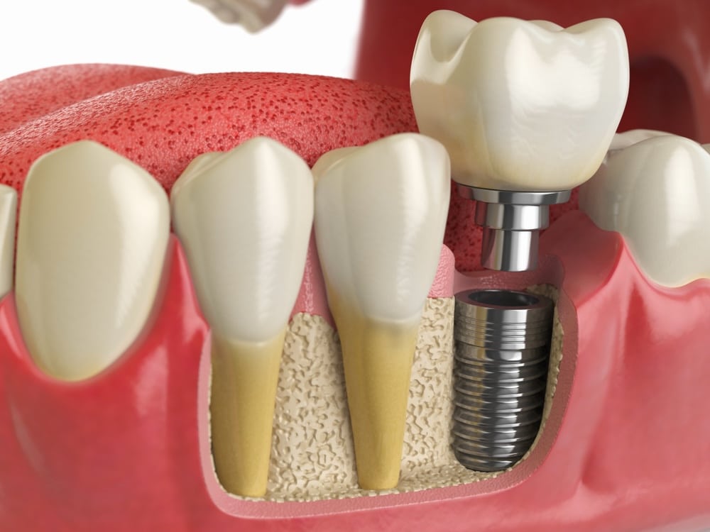 Model of a person’s teeth showing a dental implant 